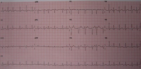 1,94-AFib