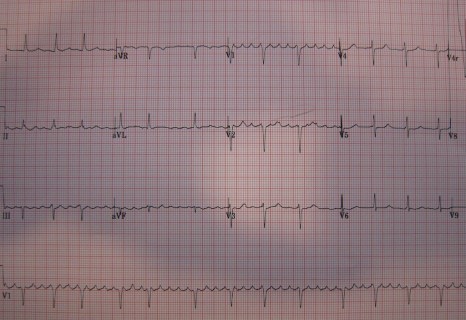 2-AtrialFlutter
