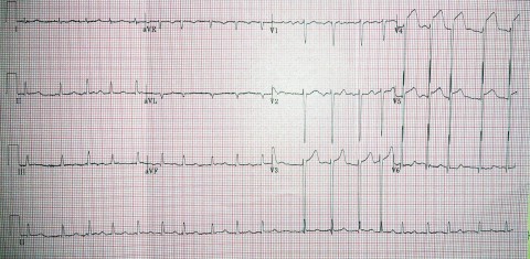 AF STEMI clot-embolus