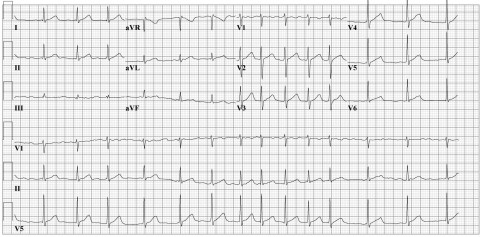 AFib - rate controlled