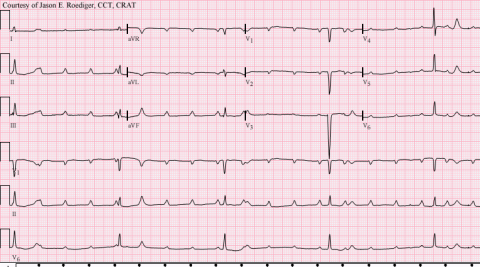 CHB - Complete_A-V_block_with_resulting_junctional_escape