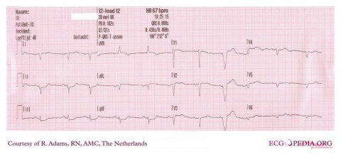 De-Dextrocardia_(CardioNetworks_ECGpedia)