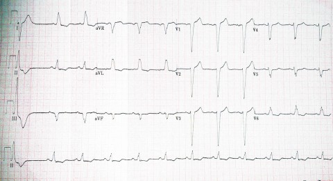 LBBB MP