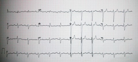 LBBB and 1HB MP