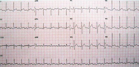 Pericarditis10