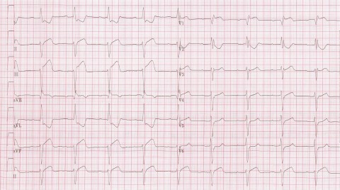 RBBB - LAD - Inf MI -  RBBB_inf_MI