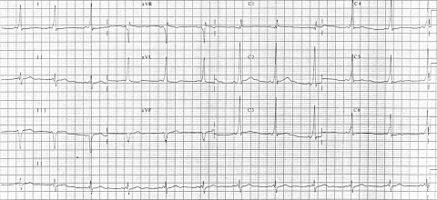 Wolff-Parkinson-White_syndrome_12_lead_EKG