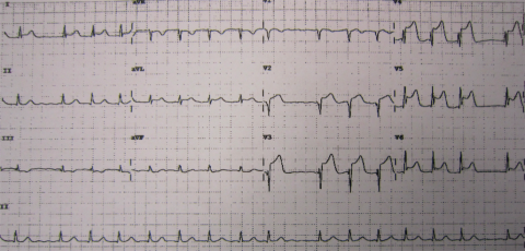 anteriorlateral MI