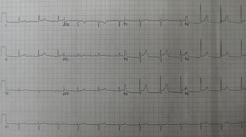 22-Pericarditis