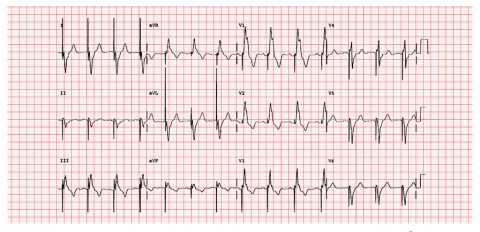 30-VentPacing