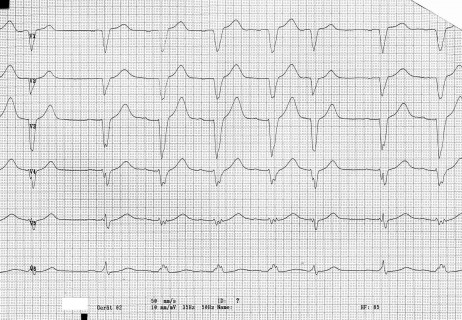 32,54-LBBB
