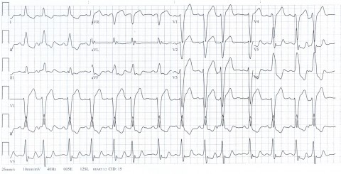 33-LBBB