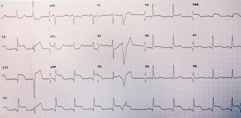 34-STEMI