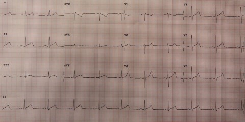46-Pericarditis