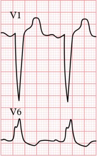 55-LBBB