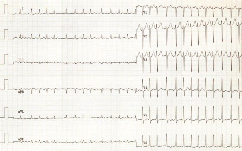 60,61-AFib