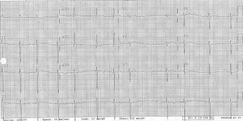62-AFib