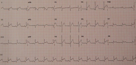 73-PericarditisMyocarditis