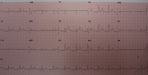 80-Pericarditis