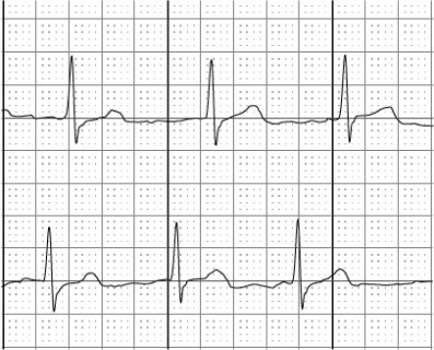 91,100-AFib