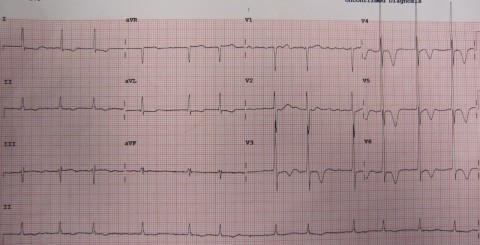 96-AFib