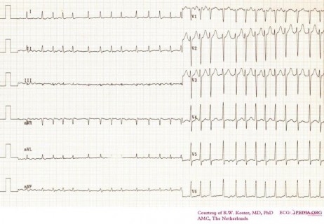 97-AFib