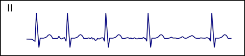 98-AFib